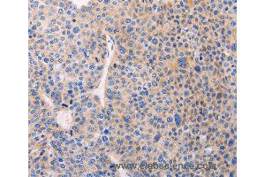 Immunohistochemistry of Human liver cancer using ADCY1 Polyclonal Antibody at dilution of 1:60 (ADCY1 antibody)