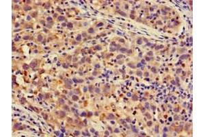 Immunohistochemistry of paraffin-embedded human pancreatic cancer using ABIN7164956 at dilution of 1:100 (PSMA4 antibody  (AA 148-184))