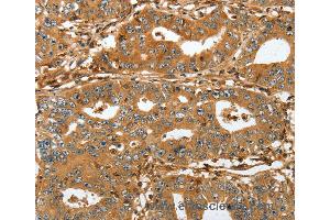 Immunohistochemistry of Human lung cancer using RAP1A Polyclonal Antibody at dilution of 1:45