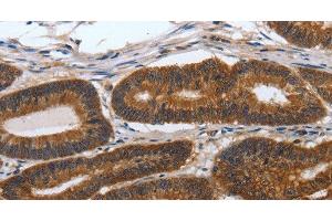 Immunohistochemistry of paraffin-embedded Human colon cancer tissue using PDCD7 Polyclonal Antibody at dilution 1:60 (PDCD7 antibody)