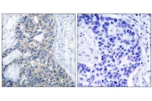 Immunohistochemical analysis of paraffin-embedded human breast carcinoma tissue using Stathmin 1 (phospho-Ser37) antibody (E011225). (Stathmin 1 antibody  (pSer37))