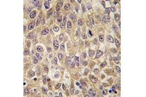 IHC analysis of FFPE human hepatocarcinoma tissue stained with AFP antibody (alpha Fetoprotein antibody  (AA 56-85))