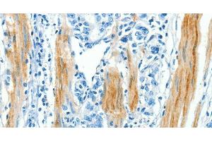 Immunohistochemistry of paraffin-embedded Human gastic cancer using CAV3 Polyclonal Antibody at dilution of 1:30 (Caveolin 3 antibody)