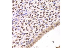 Immunohistochemistry of paraffin-embedded human adenomyosis using FKBP4 Antibody (ABIN5973289) at dilution of 1/200 (40x lens). (FKBP4 antibody)