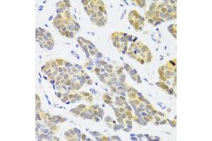 Immunohistochemistry of paraffin-embedded human breast cancer using RFC4 Antibody (ABIN5973195) at dilution of 1/100 (40x lens). (RFC4 antibody)