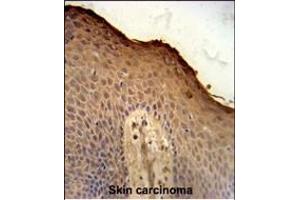 ISM1 Antibody (C-term) (ABIN651237 and ABIN2840147) immunohistochemistry analysis in formalin fixed and paraffin embedded human skin carcinoma followed by peroxidase conjugation of the secondary antibody and DAB staining. (ISM1 antibody  (AA 435-464))