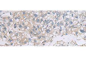Immunohistochemistry of paraffin-embedded Human liver cancer tissue using VEGFA Polyclonal Antibody at dilution of 1:45(x200) (VEGFA antibody)