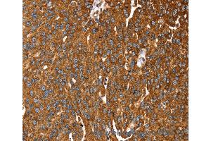 Immunohistochemistry of Human liver cancer using RASSF3 Polyclonal Antibody at dilution of 1:35