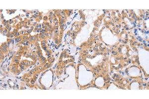 Immunohistochemistry of paraffin-embedded Human thyroid cancer tissue using TGFA Polyclonal Antibody at dilution 1:60 (TGFA antibody)