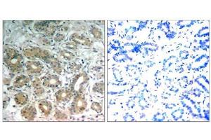 Immunohistochemical analysis of paraffin-embedded human breast carcinoma tissue, using SHP-2 (Ab-542) antibody (E021319). (PTPN11 antibody)