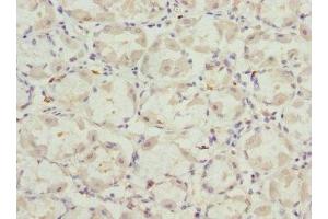 Immunohistochemistry of paraffin-embedded human gastric cancer using ABIN7175358 at dilution of 1:100 (VANGL2 antibody  (AA 1-110))
