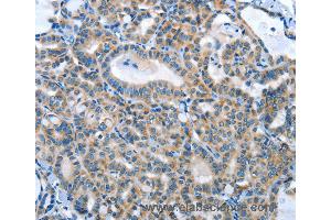 Immunohistochemistry of Human thyroid cancer using ANGPT2 Polyclonal Antibody at dilution of 1:45