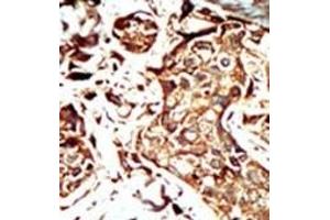 Formalin-fixed and paraffin-embedded human cancer tissue reacted with the primary antibody, which was peroxidase-conjugated to the secondary antibody, followed by AEC staining. (BRD3 antibody  (C-Term))
