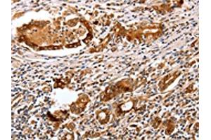 The image on the left is immunohistochemistry of paraffin-embedded Human gastric cancer tissue using ABIN7130598(PGC Antibody) at dilution 1/25, on the right is treated with fusion protein. (PGC antibody)