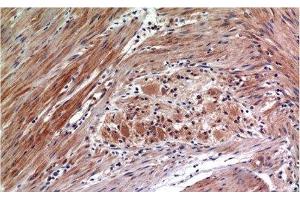 Immunohistochemistry of paraffin-embedded Human colon carcinoma tissue with Phospho-ERK 1/2 (Tyr222/205) Monoclonal Antibody at dilution of 1:200 (ERK1/2 antibody  (pTyr205, pTyr222))