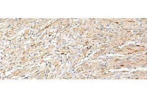 Immunohistochemistry of paraffin-embedded Human liver cancer tissue using EPRS Polyclonal Antibody at dilution of 1:60(x200) (EPRS antibody)
