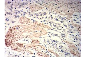 Immunohistochemical analysis of paraffin-embedded gastric cancer tissues using MYLK mouse mAb with DAB staining.