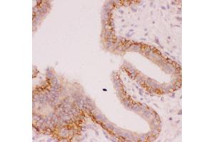 Anti-SLC9A1 Picoband antibody,  IHC(P): Human Mammary Cancer Tissue (SLC9A1 antibody  (AA 543-815))