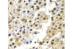 Immunohistochemistry of paraffin-embedded Human liver cancer using SYNCRIP Polyclonal Antibody at dilution of 1:100 (40x lens). (SYNCRIP antibody)