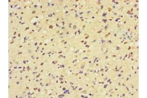 Immunohistochemistry of paraffin-embedded human glioma using ABIN7160057 at dilution of 1:100 (MAP3K8 antibody  (AA 1-300))