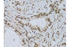 Immunohistochemistry of paraffin-embedded human gastric cancer using EMD antibody.