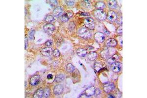 Immunohistochemical analysis of Collagen 18 alpha 1 staining in human lung cancer formalin fixed paraffin embedded tissue section. (COL18A1 antibody  (C-Term))