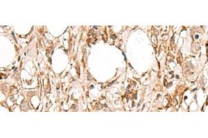Immunohistochemistry of paraffin-embedded Human breast cancer tissue using FBXW8 Polyclonal Antibody at dilution of 1:65(x200) (FBXW8 antibody)