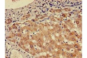 Immunohistochemistry of paraffin-embedded human liver cancer using ABIN7147724 at dilution of 1:100 (CHD5 antibody  (AA 1600-1699))