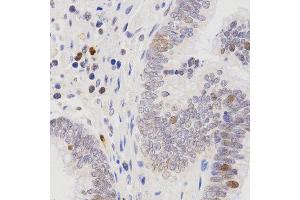 Immunohistochemistry of paraffin-embedded human rectal cancer tissue using SCTR antibody at dilution of 1:200 (x400 lens) (SCTR antibody)