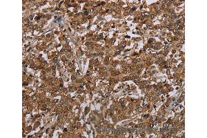 Immunohistochemistry of Human liver cancer using TBX5 Polyclonal Antibody at dilution of 1:35 (T-Box 5 antibody)