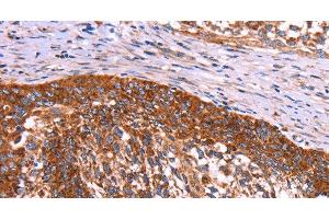 Immunohistochemistry of paraffin-embedded Human cervical cancer using ABI1 Polyclonal Antibody at dilution of 1:40 (ABI1 antibody)