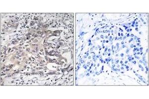 Immunohistochemistry analysis of paraffin-embedded human liver carcinoma tissue, using Cytochrome P450 4X1 Antibody.