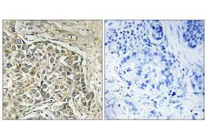 Immunohistochemistry analysis of paraffin-embedded human lung carcinoma tissue using ARSD antibody. (Arylsulfatase D antibody  (Internal Region))