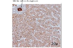 Human Liver - Hepatocarcinoma (HCC) Paraffin section, citrate, dilution 1:100 (Annexin IV antibody)