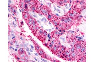 Anti-BAI3 antibody IHC of human Lung, Adenocarcinoma. (BAI3 antibody  (C-Term))