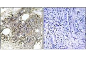 Immunohistochemistry analysis of paraffin-embedded human breast carcinoma tissue, using TGF beta Receptor III (Ab-842) Antibody. (TGFBR3 antibody)
