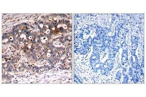 Immunohistochemical analysis of paraffin-embedded human breast carcinoma tissue, using Shc1 (Ab-427) antibody (E021317). (SHC1 antibody)