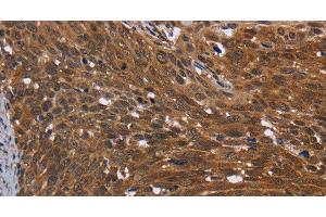 Immunohistochemistry of paraffin-embedded Human cervical cancer using FHIT Polyclonal Antibody at dilution of 1:30 (FHIT antibody)