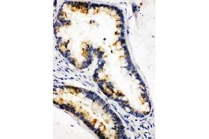Anti-Kallikrein 6 antibody, IHC(P) IHC(P): Human Intestinal Cancer Tissue (Kallikrein 6 antibody  (C-Term))