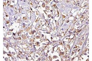 ABIN6277546 at 1/100 staining Human breast cancer tissue by IHC-P. (VAPB antibody  (C-Term))
