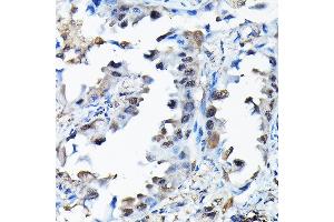 Immunohistochemistry of paraffin-embedded human lung cancer using RBBP9 Rabbit pAb (ABIN6129095, ABIN6146752, ABIN6146753 and ABIN6220638) at dilution of 1:200 (40x lens). (RBBP9 antibody  (AA 1-186))