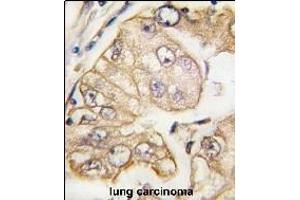 Formalin-fixed and paraffin-embedded human lung carcinoma tissue reacted with VGFR3 Monoclonal Antibody (ABIN387818 and ABIN2843906) , which was peroxidase-conjugated to the secondary antibody, followed by DAB staining. (FLT4 antibody)