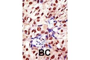 Formalin-fixed and paraffin-embedded human cancer tissue reacted with the primary antibody, which was peroxidase-conjugated to the secondary antibody, followed by DAB staining. (PRMT2 antibody  (N-Term))