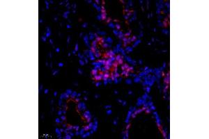 Immunofluorescence of paraffin embedded human breast cancer using Suv39h2 (ABIN7075771) at dilution of 1:2000 (400x lens)