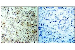 Immunohistochemical analysis of paraffin- embedded human breast carcinoma tissue, using CDK2 (phospho-Thr160) antibody (E011133).