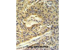 ATP5A1 Antibody (C-term) IHC analysis in formalin fixed and paraffin embedded lung carcinoma followed by peroxidase conjugation of the secondary antibody and DAB staining. (MT-ATP6 antibody  (C-Term, Subunit alpha))