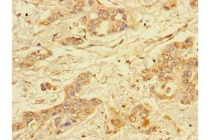 Immunohistochemistry of paraffin-embedded human pancreatic cancer using ABIN7143770 at dilution of 1:100 (ALG2 antibody  (AA 303-405))