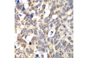 Immunohistochemistry of paraffin-embedded human esophageal cancer using PARN antibody (ABIN5972174) at dilution of 1/100 (40x lens). (PARN antibody)