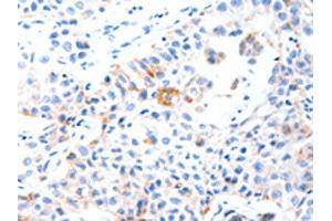 The image on the left is immunohistochemistry of paraffin-embedded Human lung cancer tissue using ABIN7191546(MUC3A Antibody) at dilution 1/60, on the right is treated with synthetic peptide. (MUC3A antibody)
