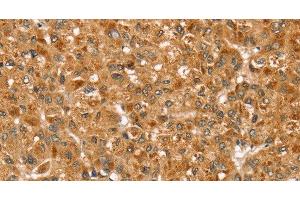 Immunohistochemistry of paraffin-embedded Human liver cancer using STX3 Polyclonal Antibody at dilution of 1:35 (STX3 antibody)